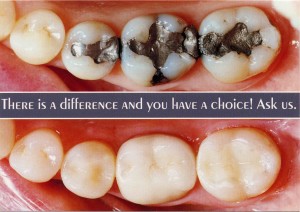 composite vs amalgam