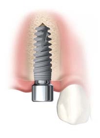 implant placement