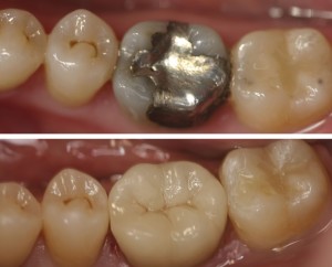 inlay vs amalgam