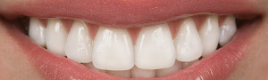 salinas-dental-veneers