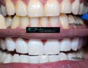 Teeth Whitening in Maadi