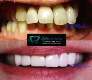 Veneers in maadi and hollywood smile